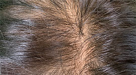 薄毛と抜け毛の育毛