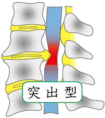 突出型ヘルニア