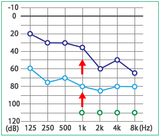 子供の突発性難聴、ムンプス難聴