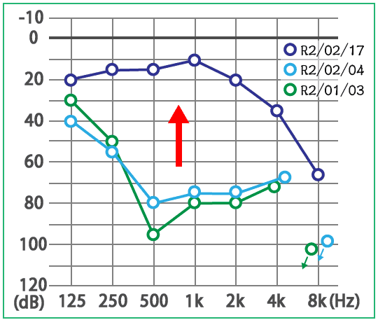 突発性難聴・メニエール病