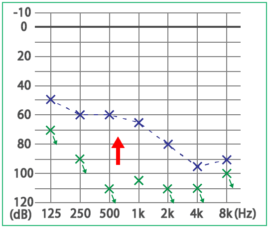 めまい・メニエール病・PPPD