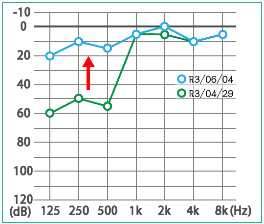 急性低音障害型感音難聴