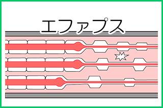 顔面神経麻痺：後遺症のけいれん