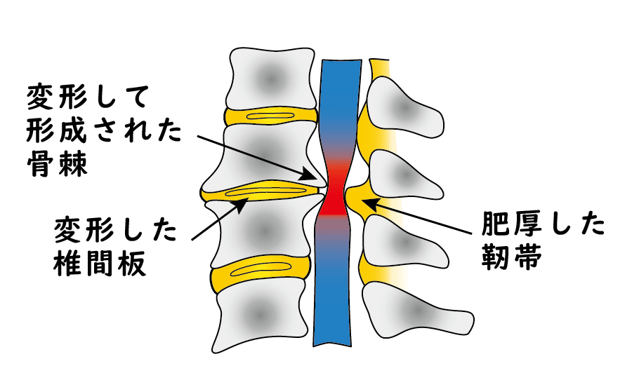脊柱菅狭窄症の治療