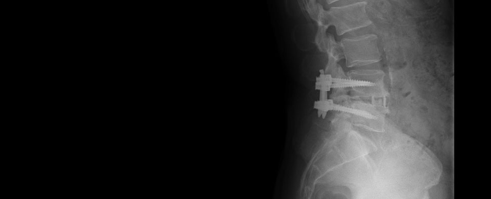 脊柱菅狭窄症の手術