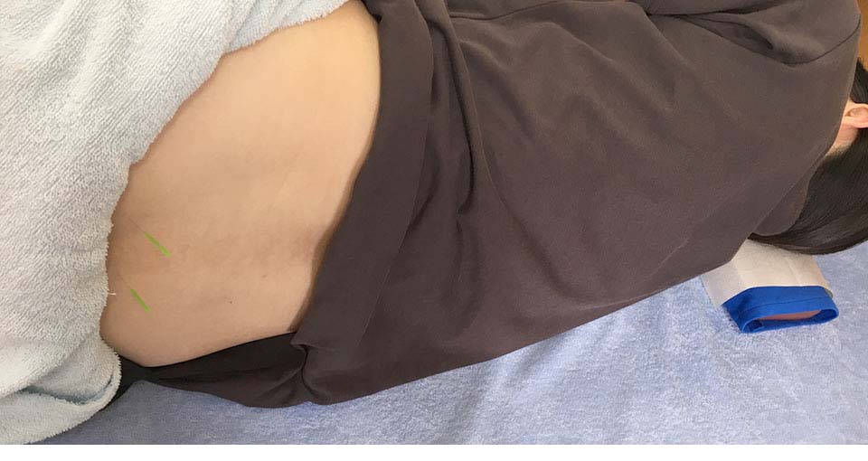 無痛分娩の鍼灸治療