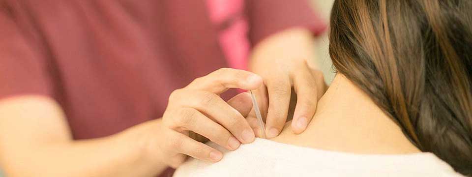 抜け毛に対する鍼灸治療