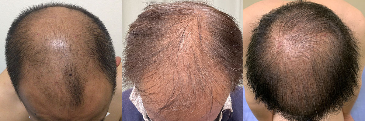 新城市の薄毛・脱毛に対する発毛外来