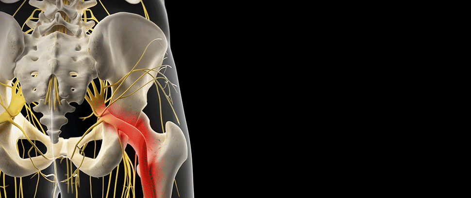 坐骨神経痛の治療